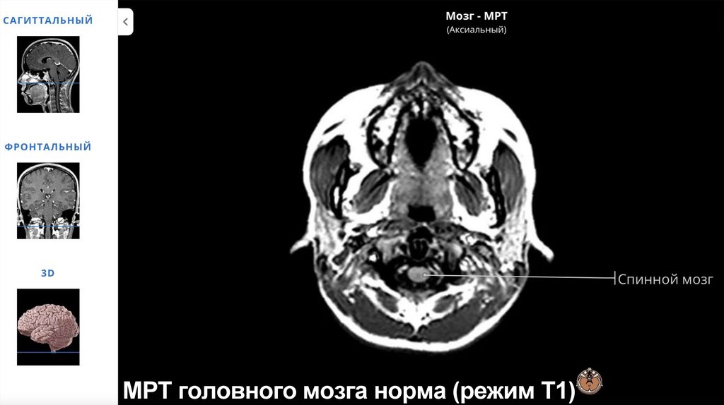 МРТ головного мозга норма (режим Т1)