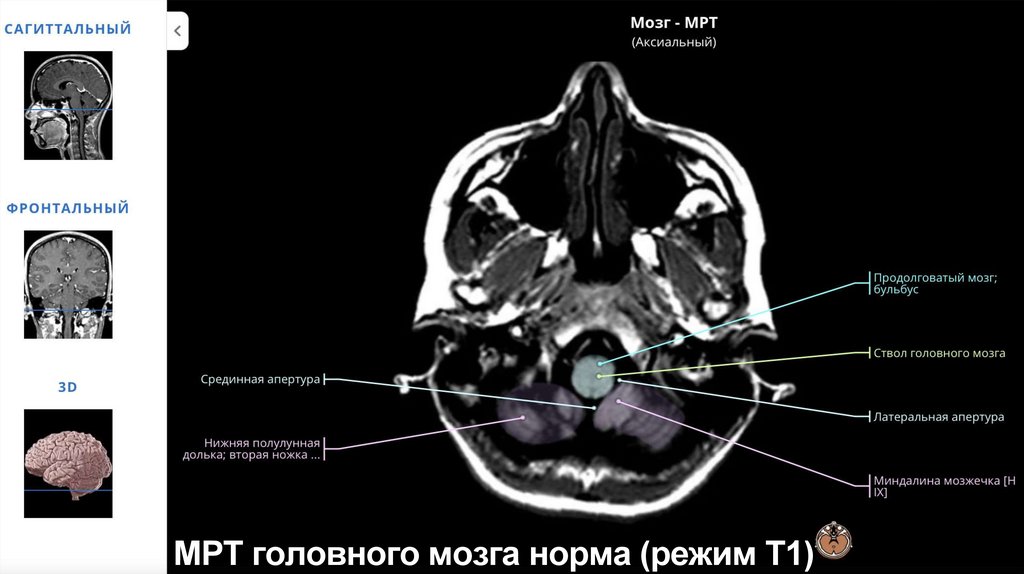 МРТ головного мозга норма (режим Т1)