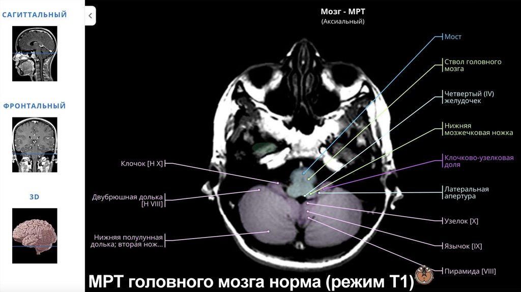МРТ головного мозга норма (режим Т1)