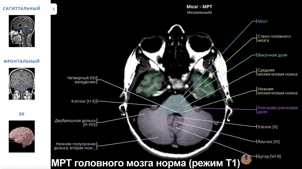 МРТ головного мозга норма (режим Т1)