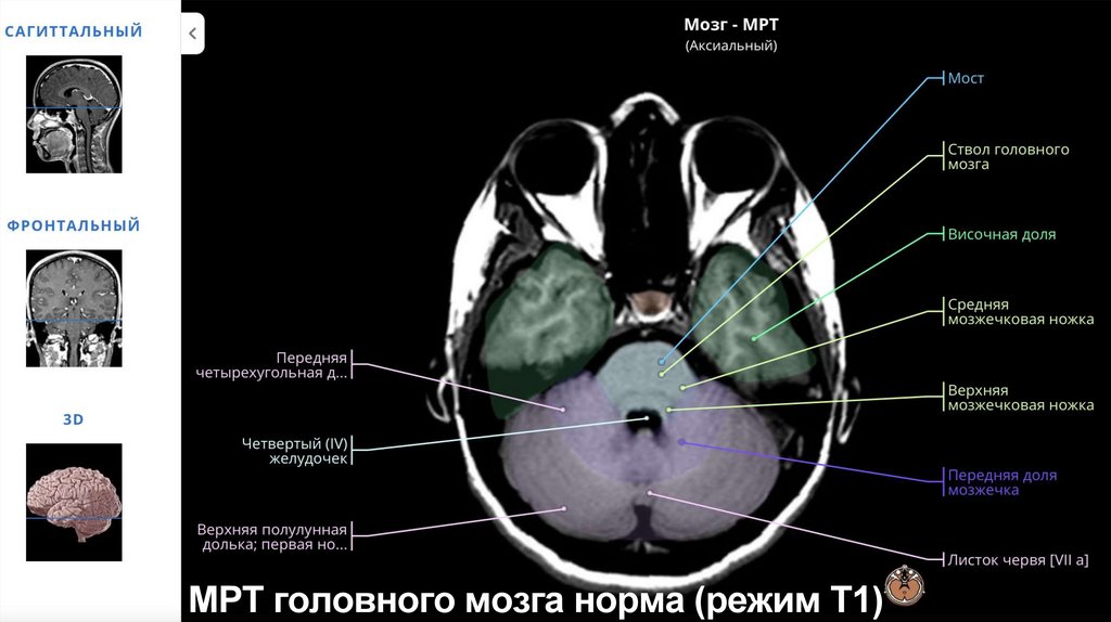 МРТ головного мозга норма (режим Т1)