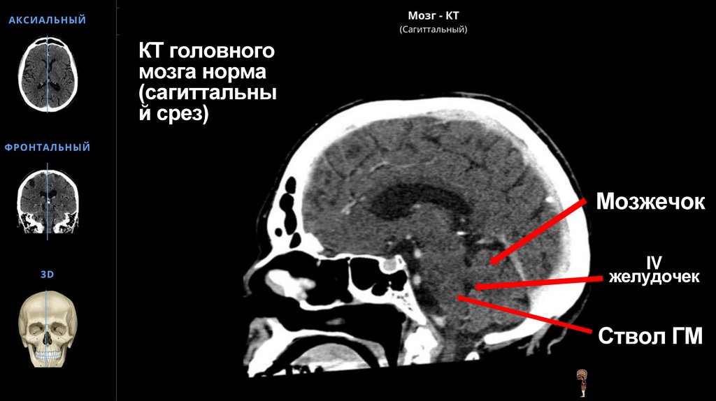 КТ головного мозга норма (сагиттальный срез)