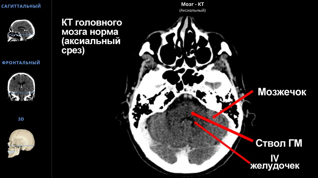 КТ головного мозга норма (аксиальный срез)