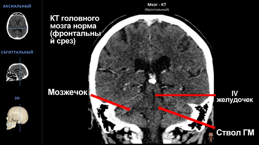 КТ головного мозга норма (фронтальный срез)