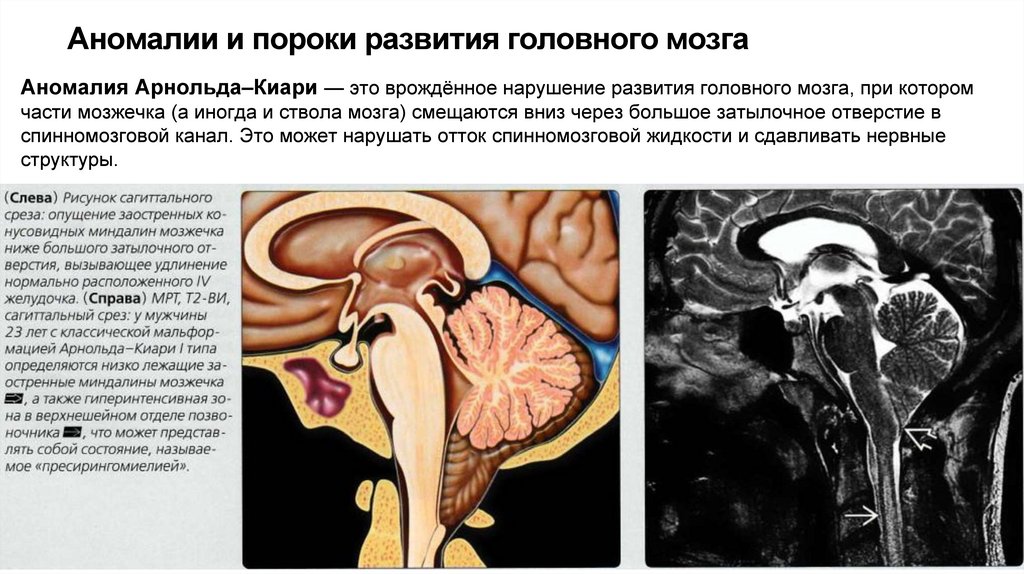 Аномалии и пороки развития головного мозга