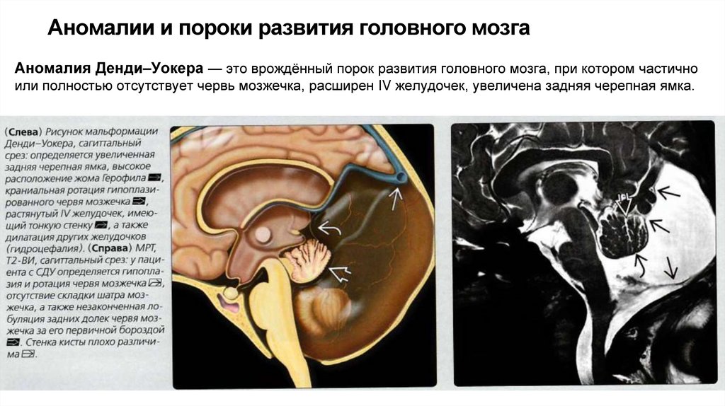Аномалии и пороки развития головного мозга