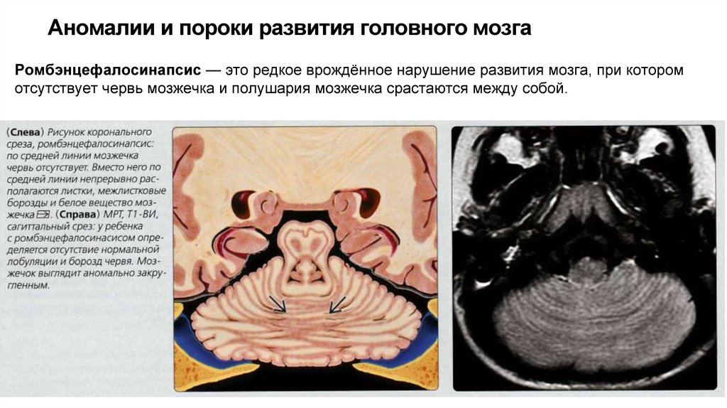 Аномалии и пороки развития головного мозга