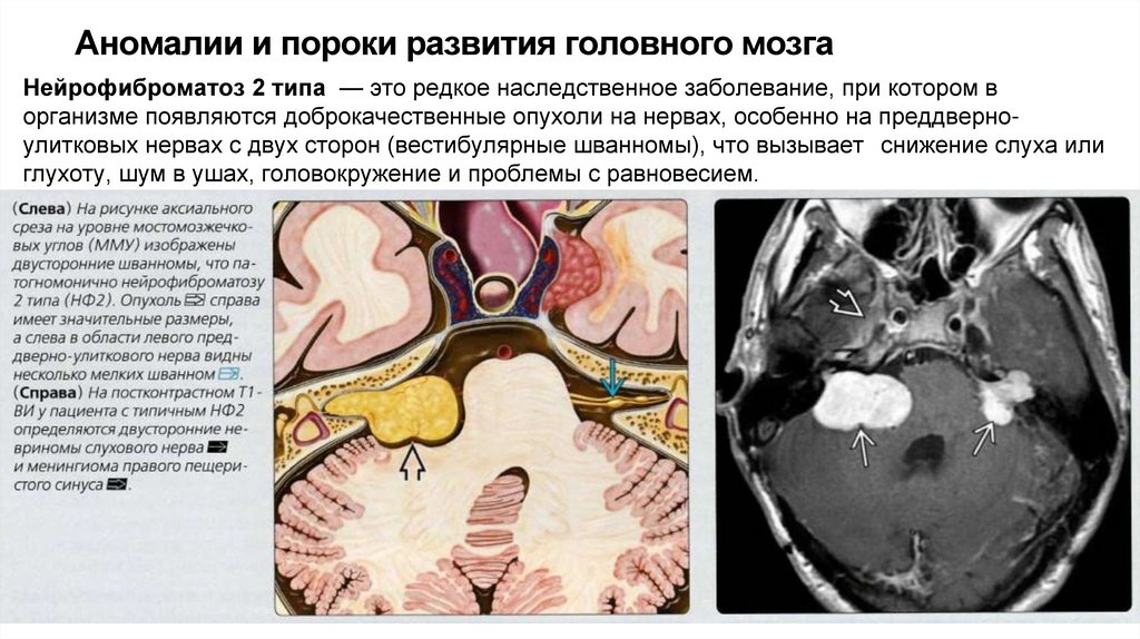 Аномалии и пороки развития головного мозга