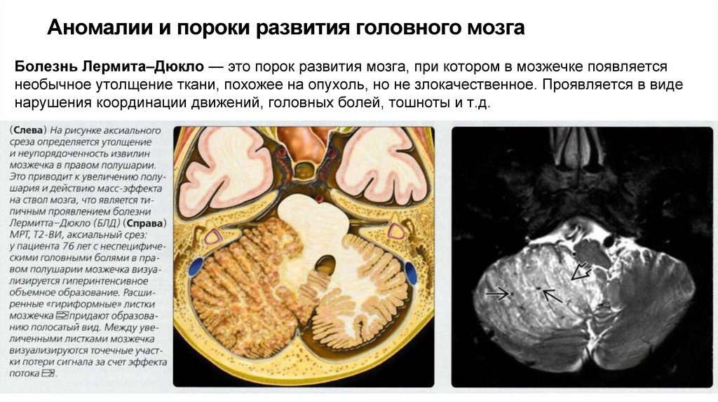 Аномалии и пороки развития головного мозга