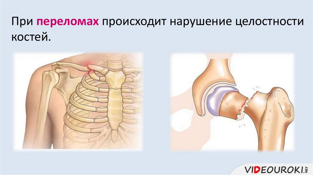При переломах происходит нарушение целостности костей.