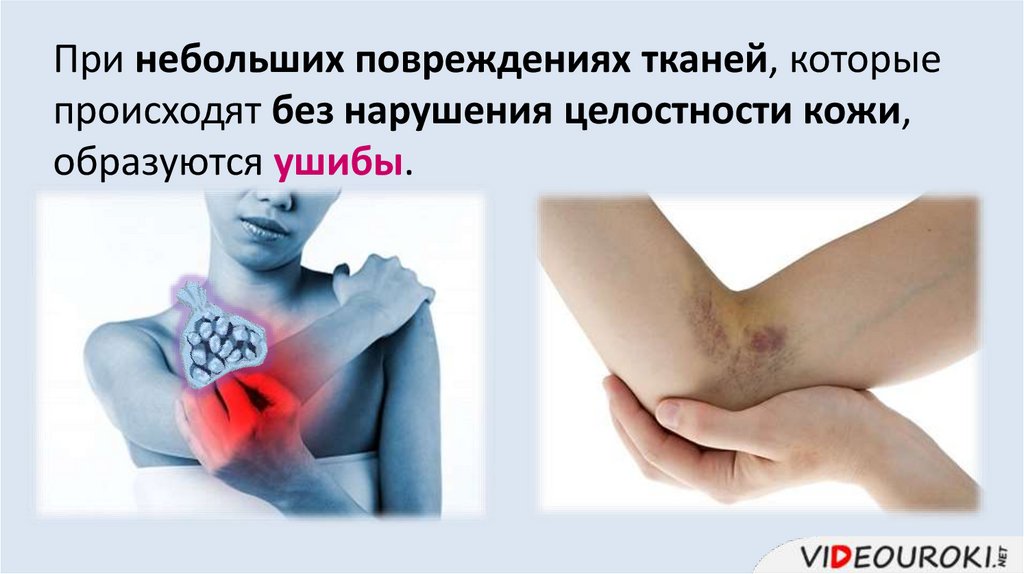 При небольших повреждениях тканей, которые происходят без нарушения целостности кожи, образуются ушибы.