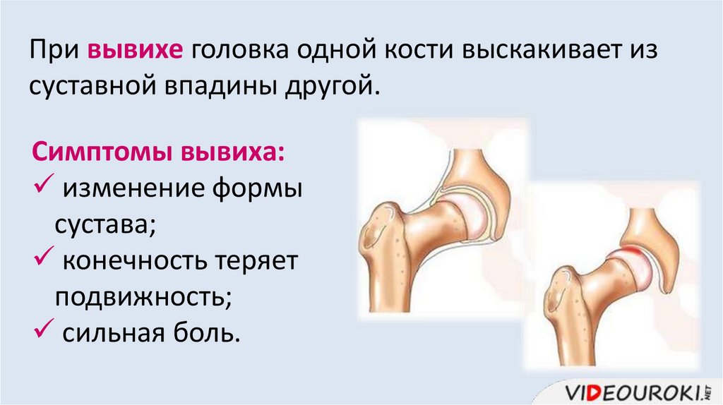 При вывихе головка одной кости выскакивает из суставной впадины другой.