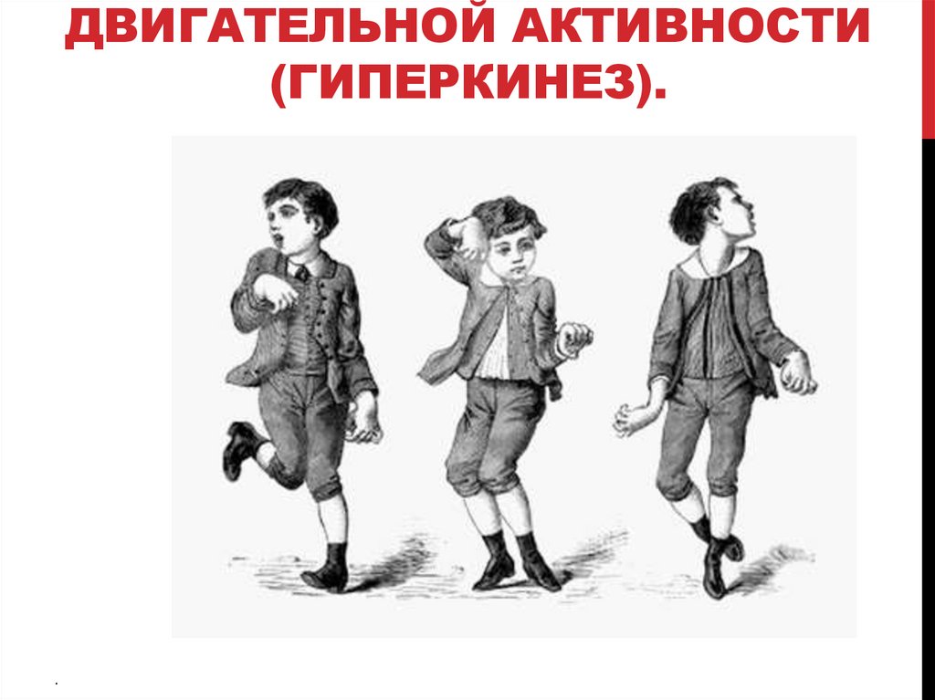 Хорея - повышение двигательной активности (гиперкинез).