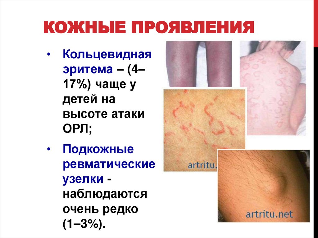 Кожные проявления