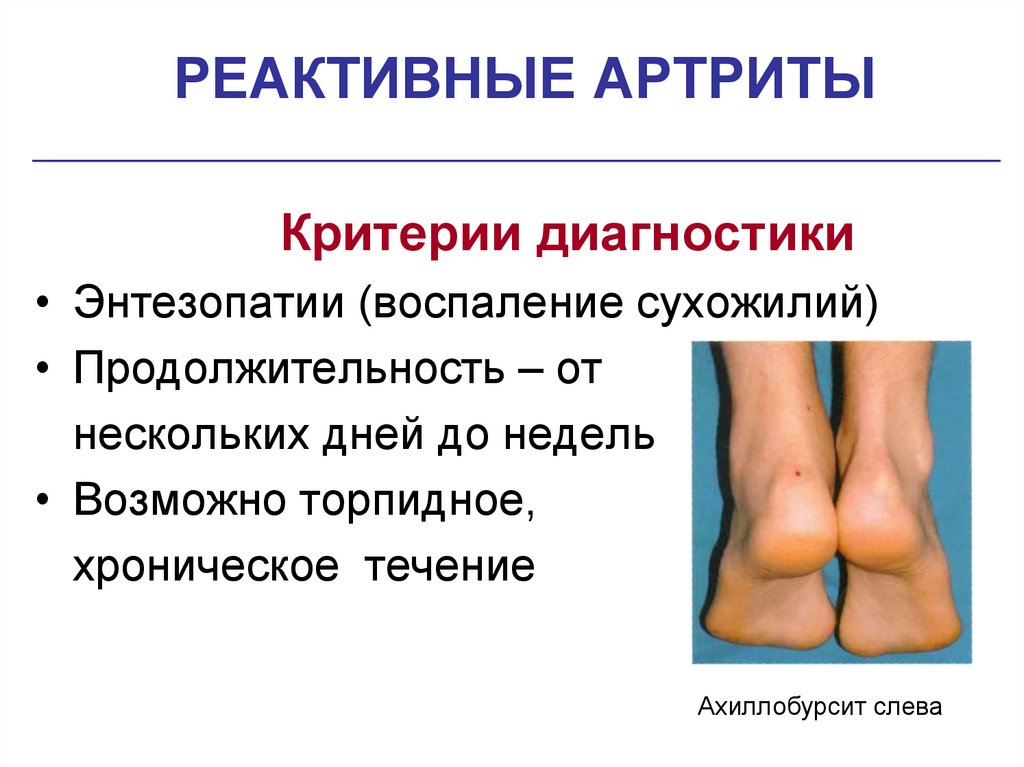 РЕАКТИВНЫЕ АРТРИТЫ