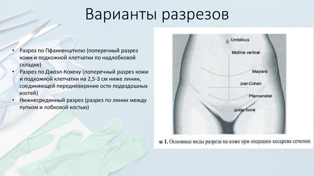 Варианты разрезов