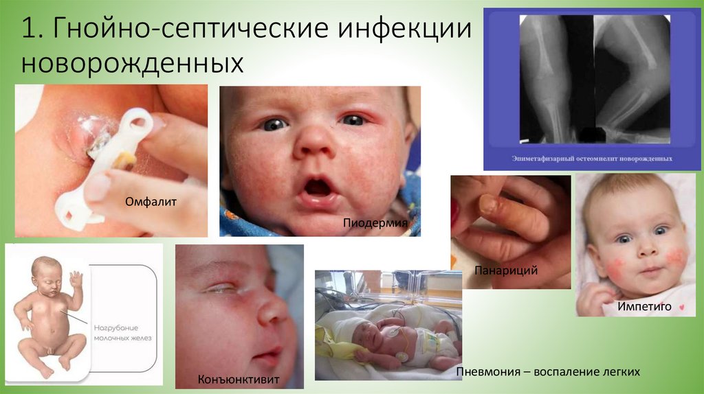 1. Гнойно-септические инфекции новорожденных