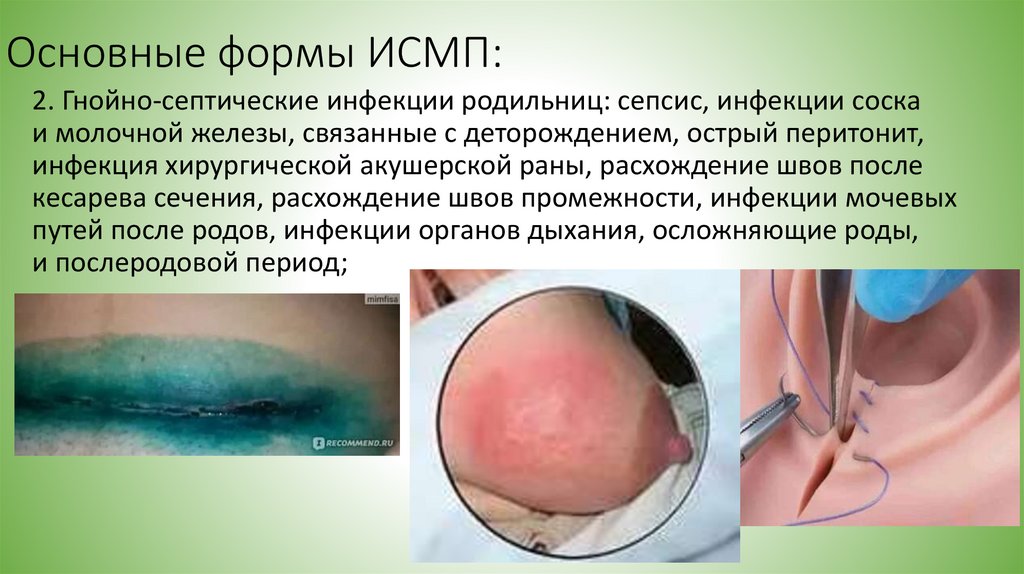 Основные формы ИСМП: