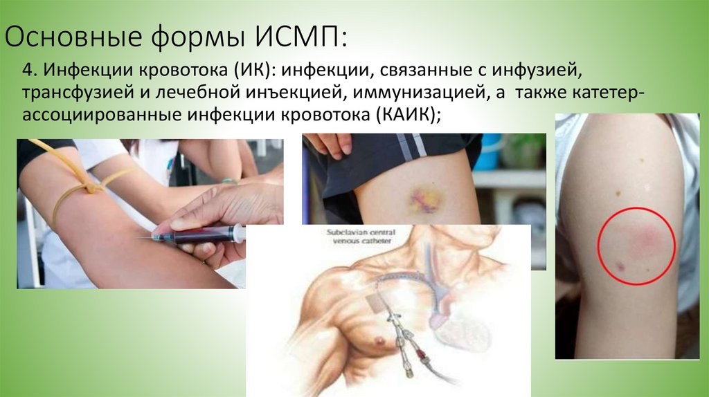 Основные формы ИСМП: