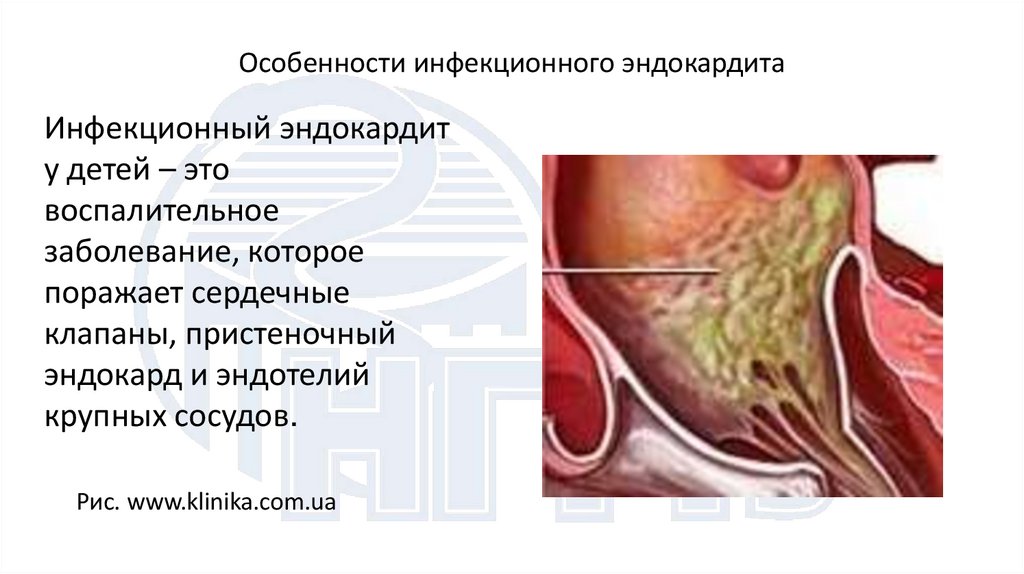 Особенности инфекционного эндокардита