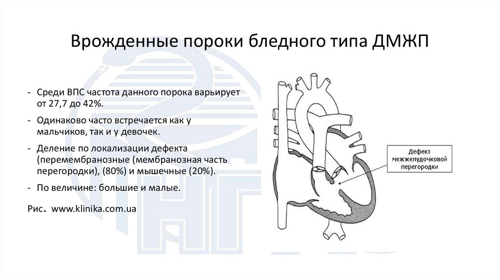 Врожденные пороки бледного типа ДМЖП