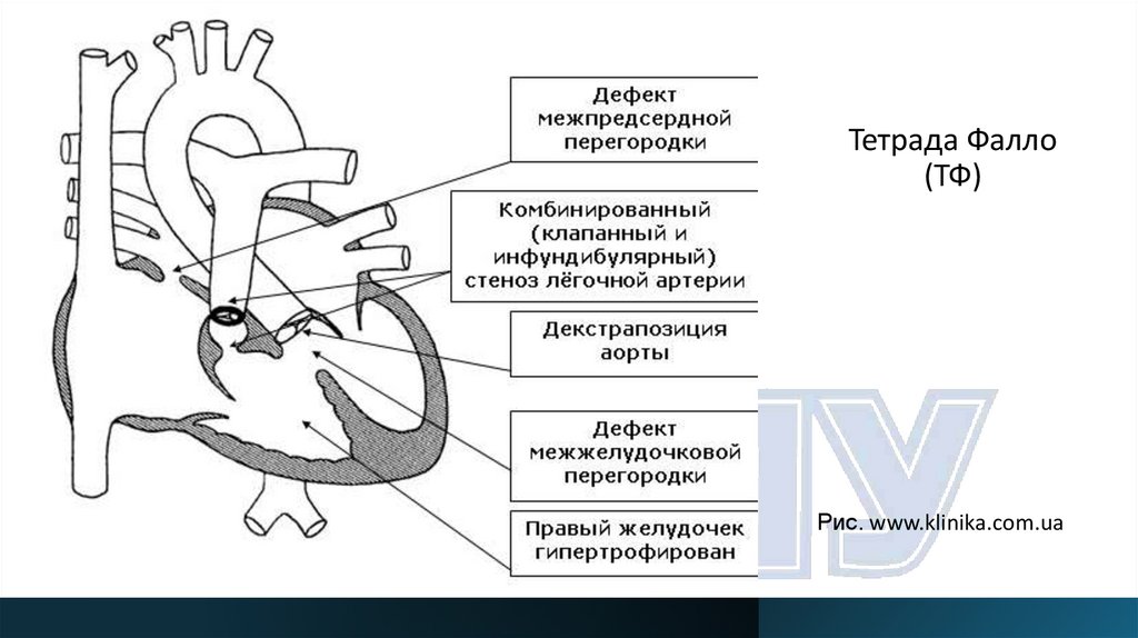 Тетрада Фалло (ТФ)