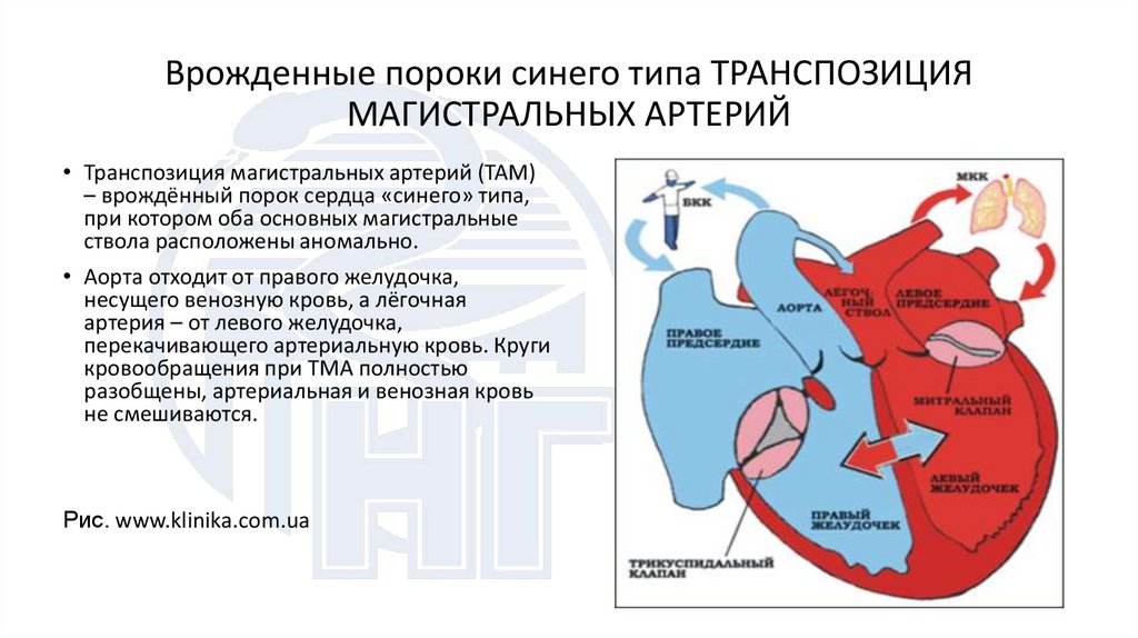 Врожденные пороки синего типа ТРАНСПОЗИЦИЯ МАГИСТРАЛЬНЫХ АРТЕРИЙ