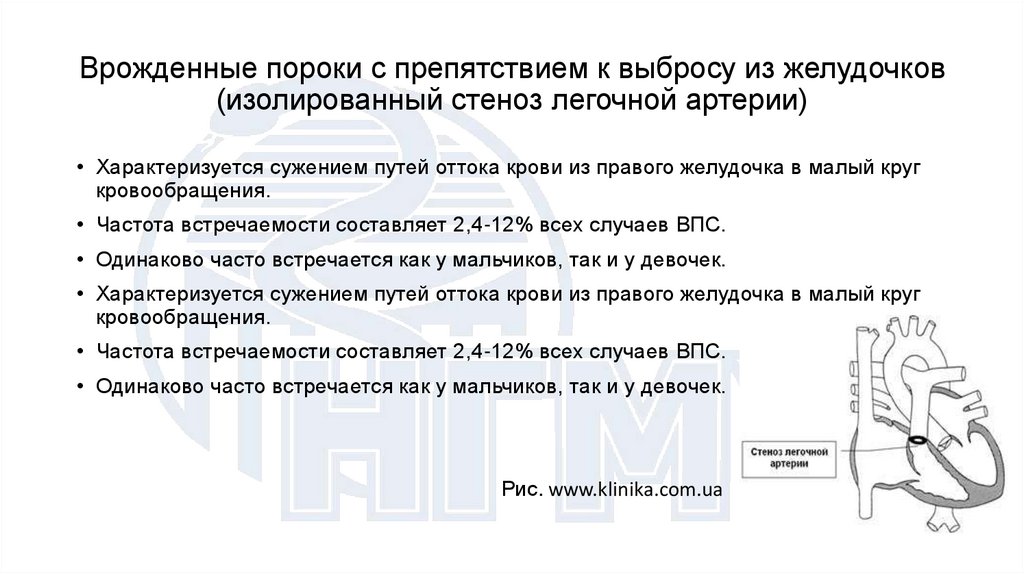 Врожденные пороки с препятствием к выбросу из желудочков (изолированный стеноз легочной артерии)
