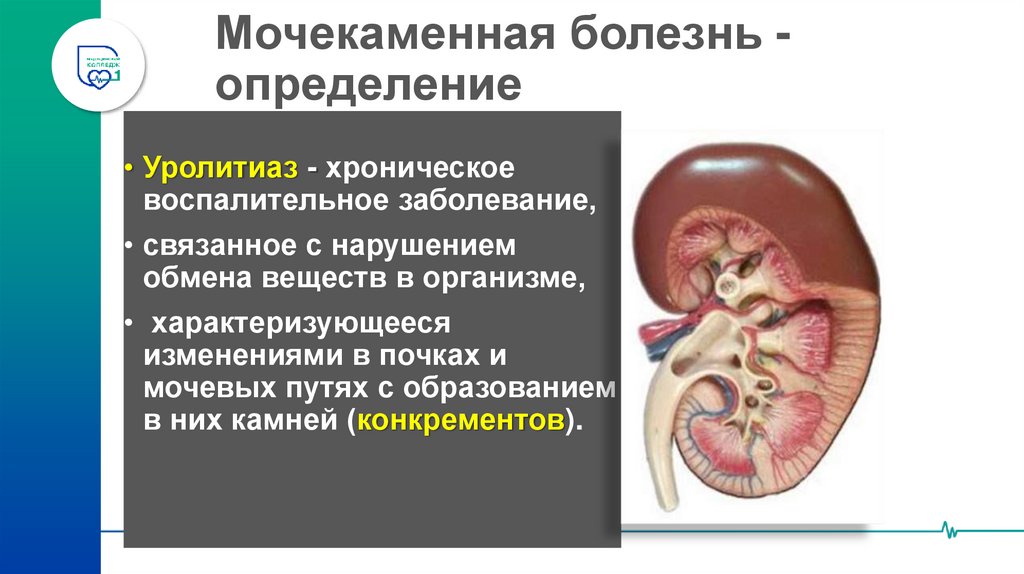 Мочекаменная болезнь - определение