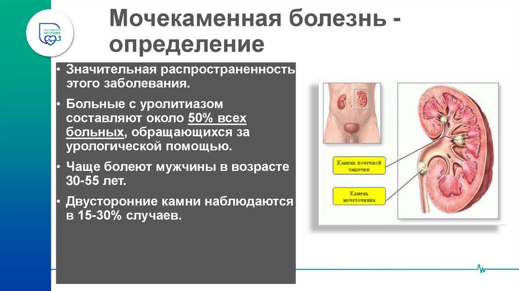 Мочекаменная болезнь - определение