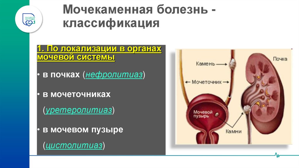 Мочекаменная болезнь - классификация