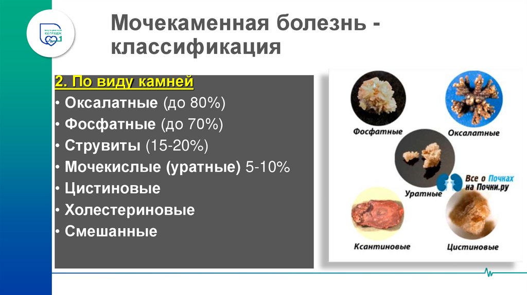 Мочекаменная болезнь - классификация