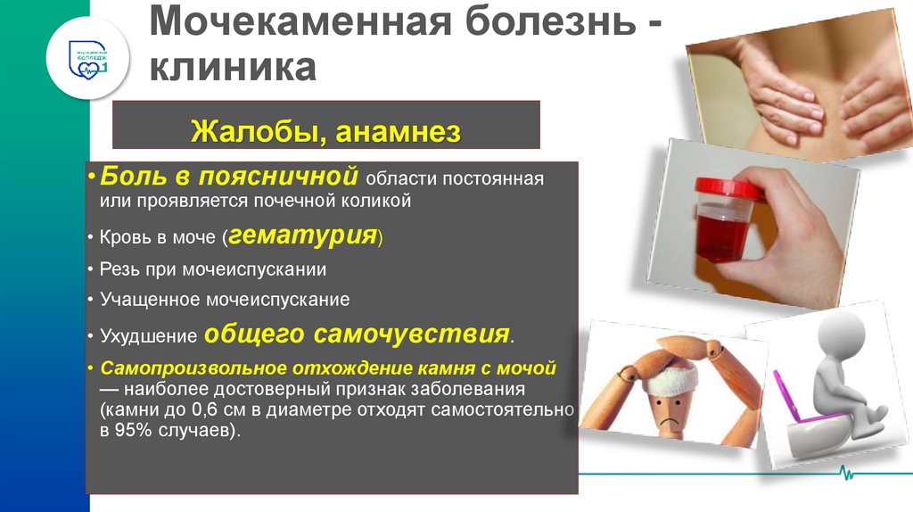 Мочекаменная болезнь - клиника