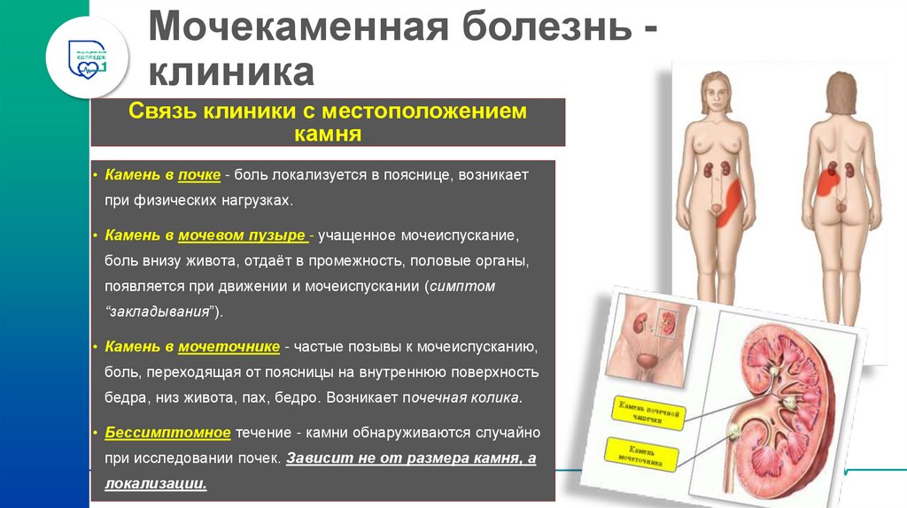 Мочекаменная болезнь - клиника