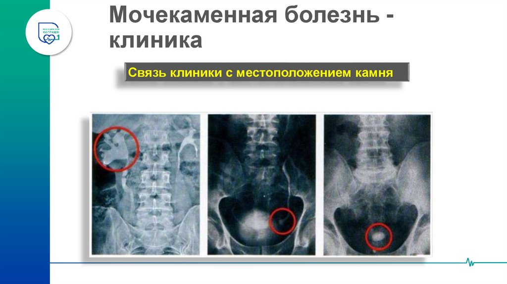Мочекаменная болезнь - клиника