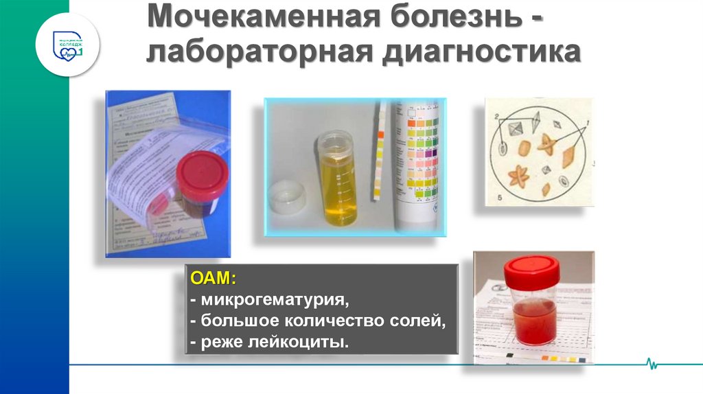 Мочекаменная болезнь -лабораторная диагностика
