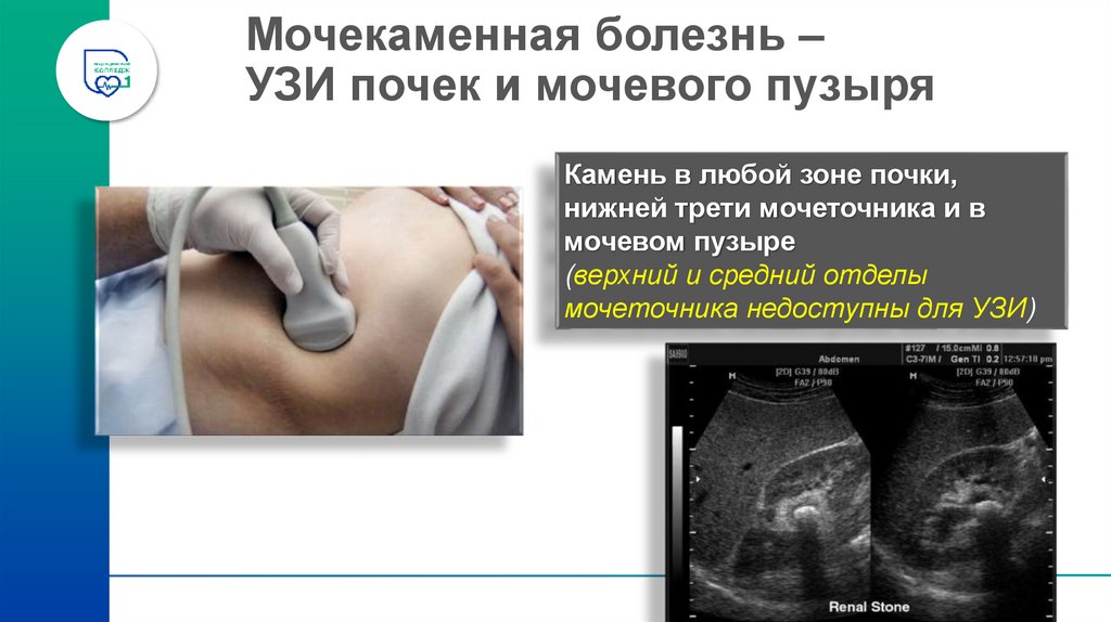 Мочекаменная болезнь – УЗИ почек и мочевого пузыря