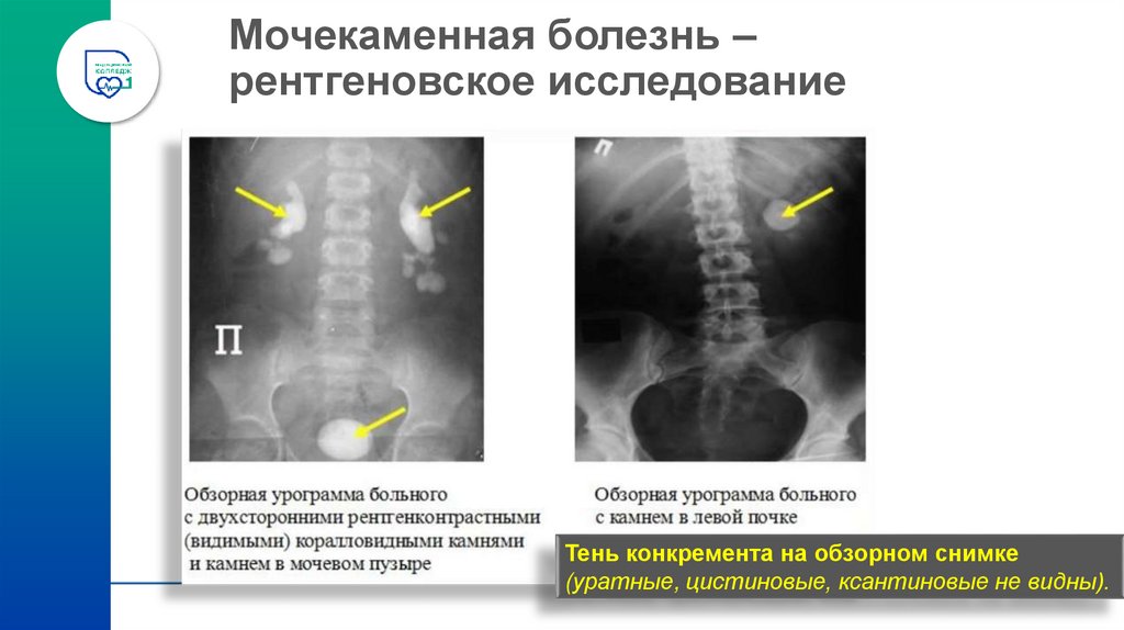 Мочекаменная болезнь – рентгеновское исследование