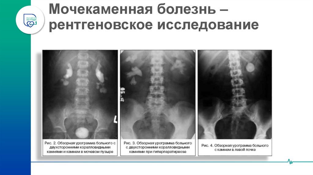 Мочекаменная болезнь – рентгеновское исследование