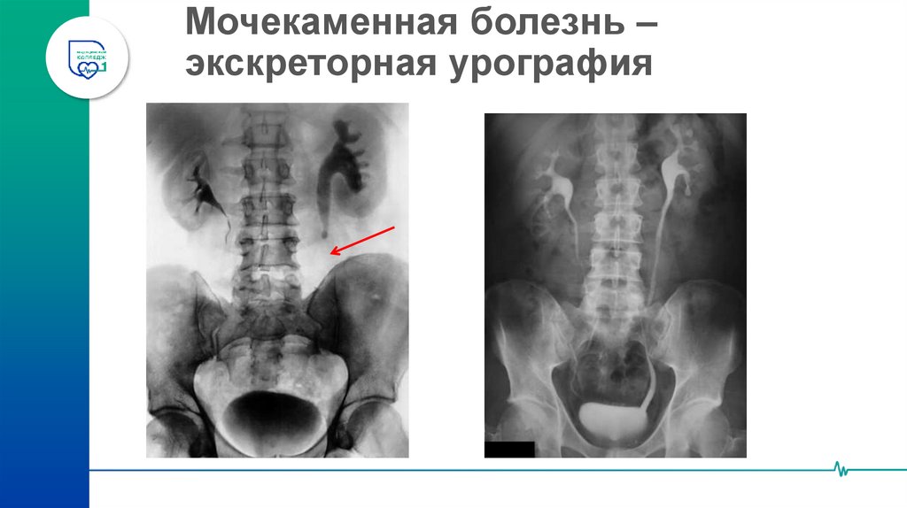 Мочекаменная болезнь – экскреторная урография