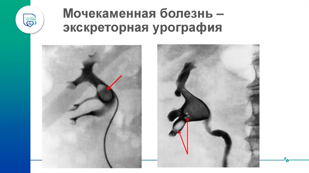 Мочекаменная болезнь – экскреторная урография
