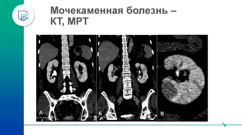 Мочекаменная болезнь – КТ, МРТ