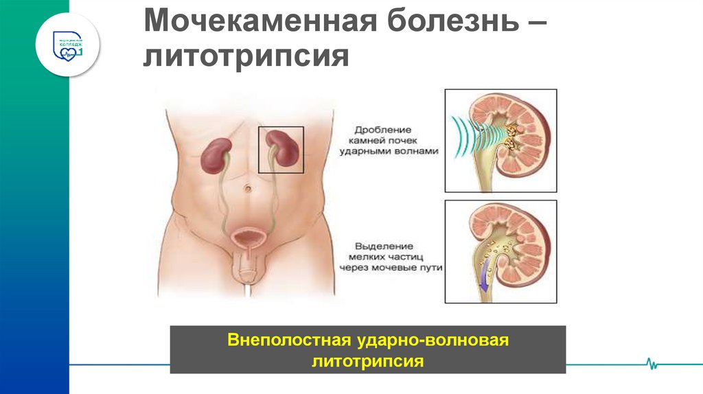 Мочекаменная болезнь – литотрипсия
