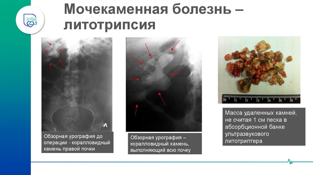 Мочекаменная болезнь – литотрипсия