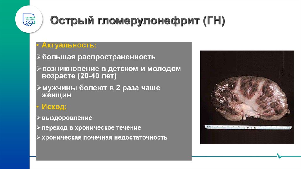 Острый гломерулонефрит (ГН)