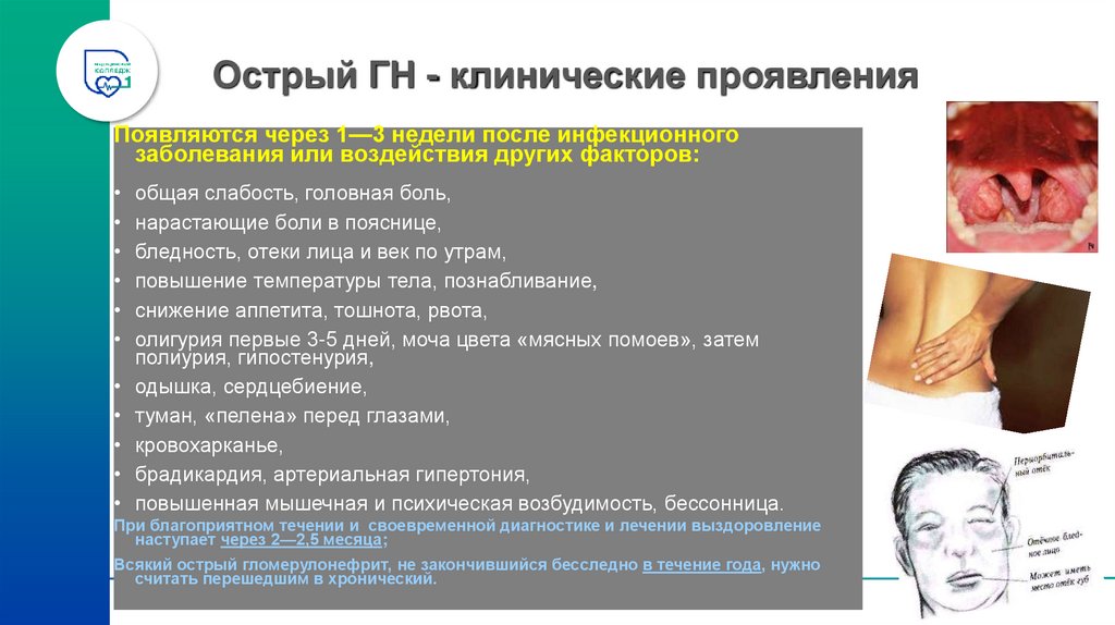 Острый ГН - клинические проявления