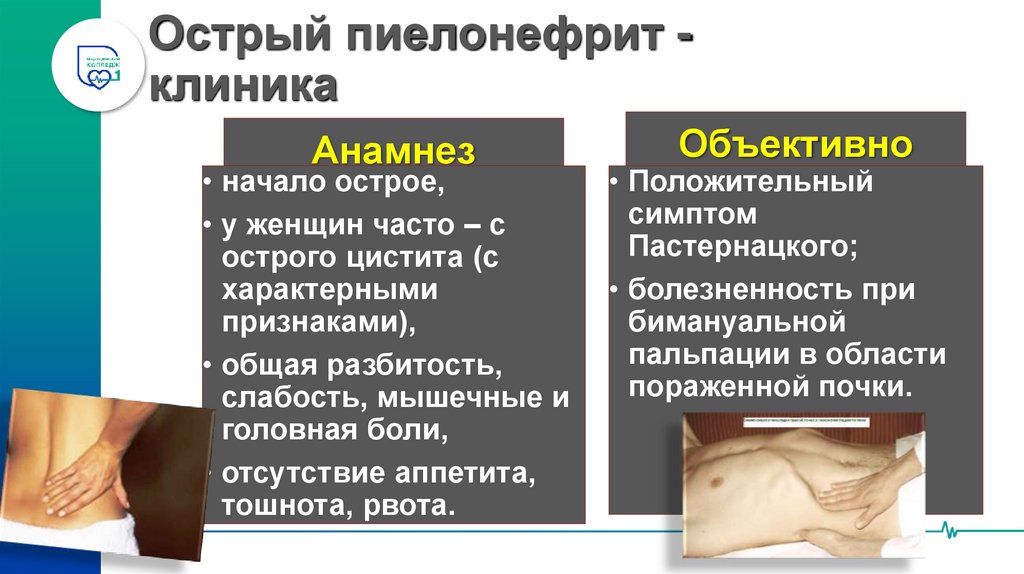 Острый пиелонефрит - клиника