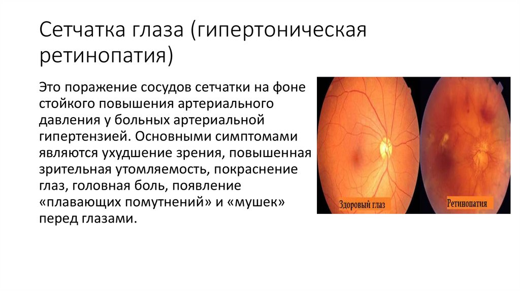 Сетчатка глаза (гипертоническая ретинопатия)