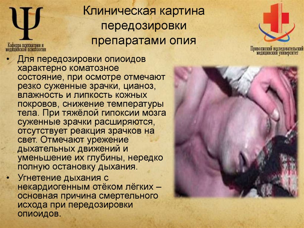 Клиническая картина передозировки препаратами опия