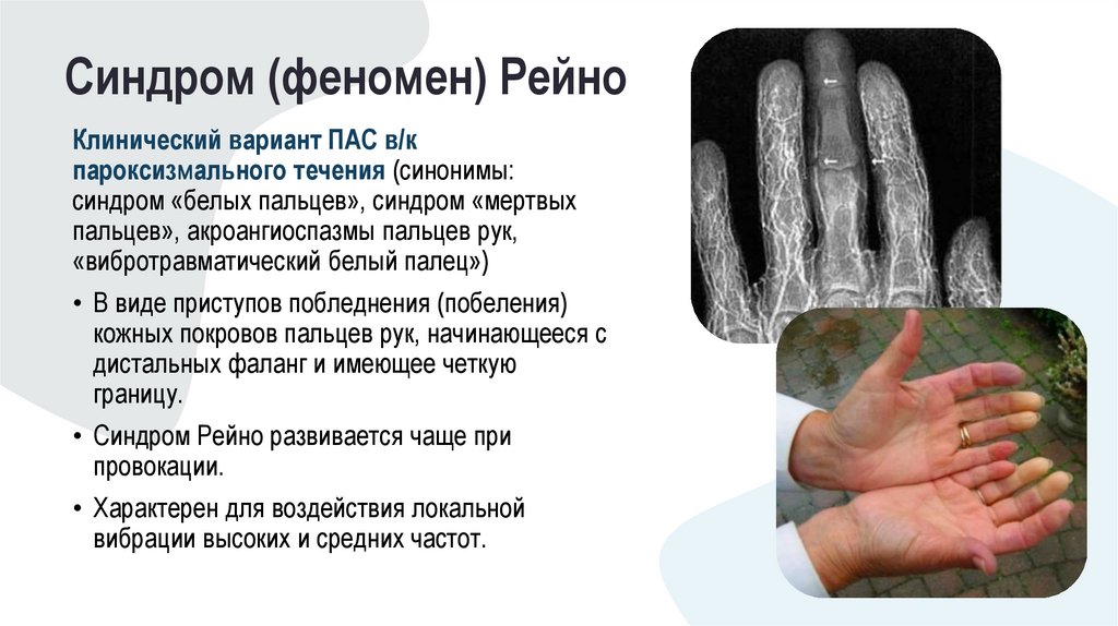 Синдром (феномен) Рейно